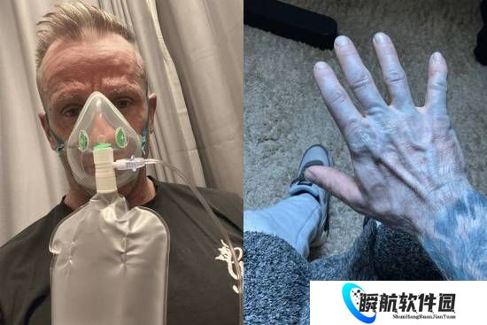 英国男子全身变蓝送去急救！医生一擦：床单掉色