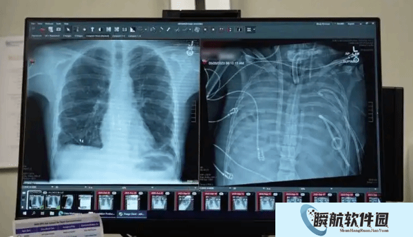 全球首例：无肺男子活了48小时 成功等到新肺移植