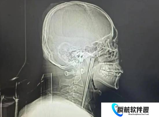 男子误吞12厘米筷子忍了8年才取出 网友：是个狠人
